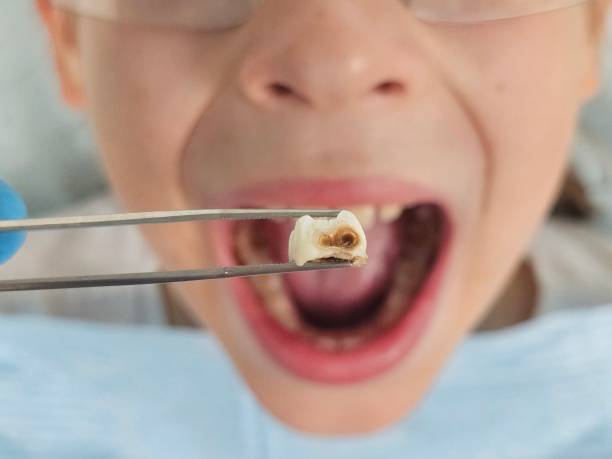 Best Emergency Wisdom Teeth Removal in Perryton, TX